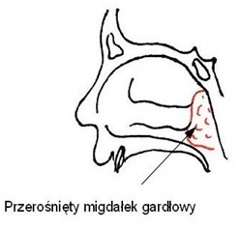 Przerośnięty migdałek gardłowy
