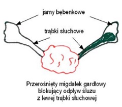 Schemat lokalizacji ujść trąbek słuchowych w pobliżu migdałka gardłowego